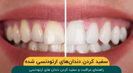 سفید-کردن-دندان-های-ارتودنسی-شده